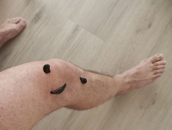  Blutegeltherapie